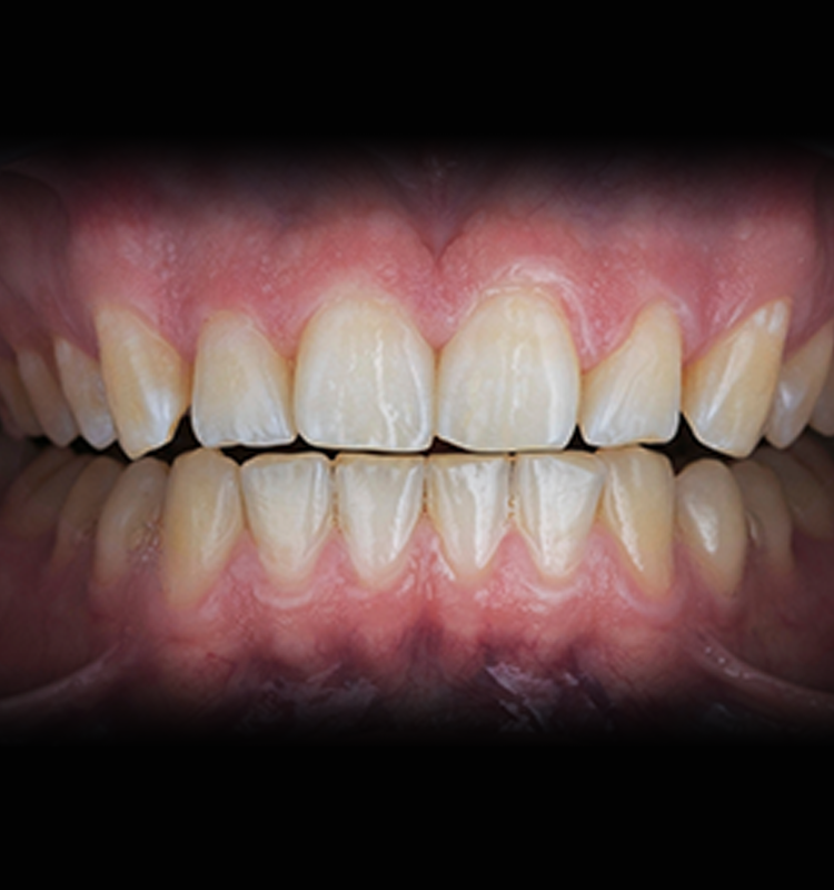 Before - الأسنان