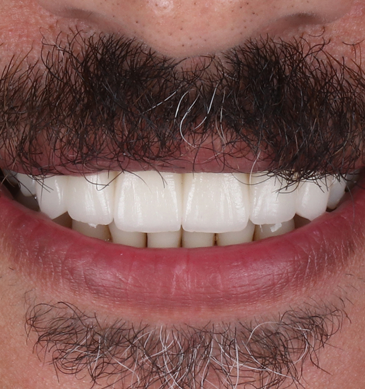 After - الأسنان