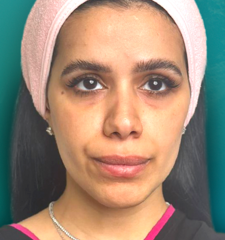 Before - الجلدية