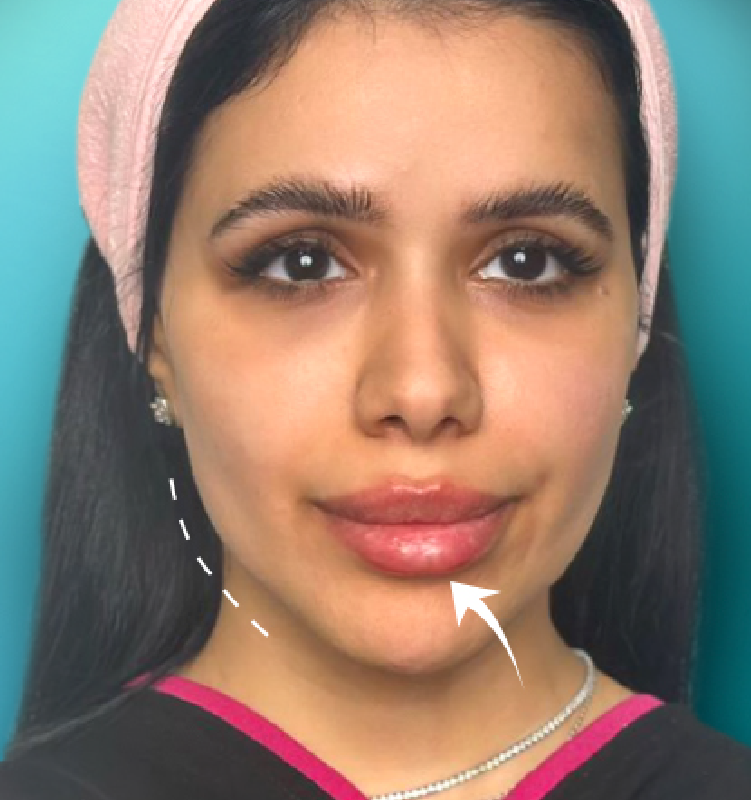 After - الجلدية