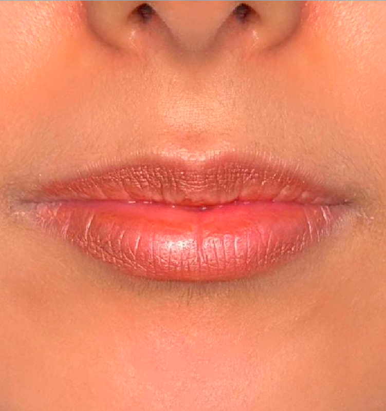 Before - الجلدية