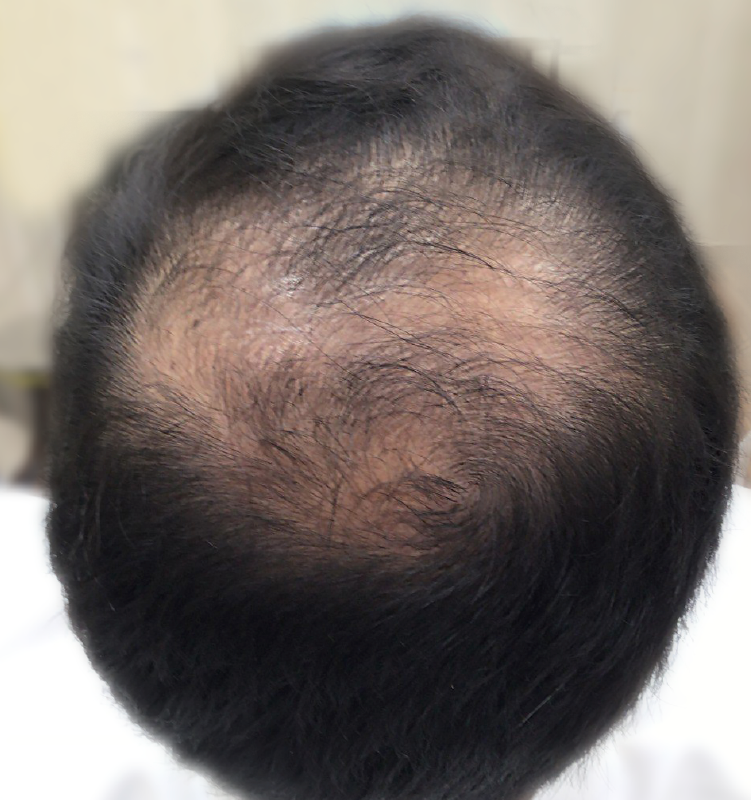 Before - الجلدية