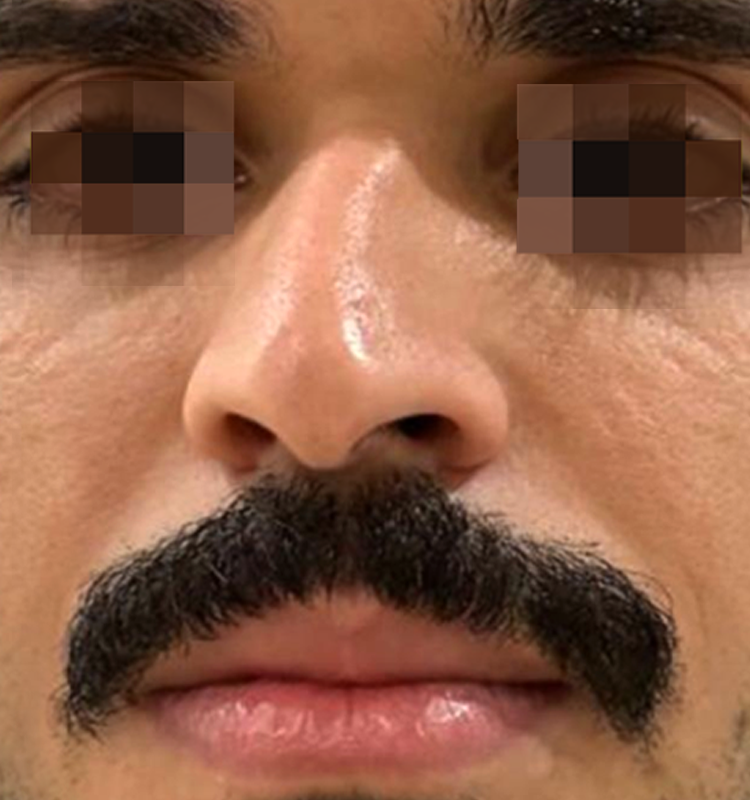 Before - التجميل الجراحي