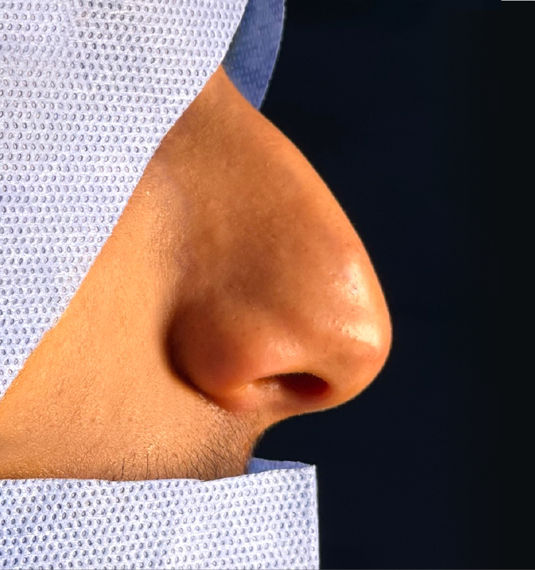 Before - التجميل الجراحي