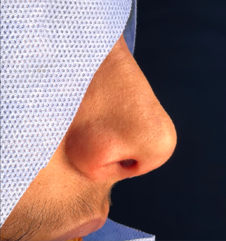 After - التجميل الجراحي