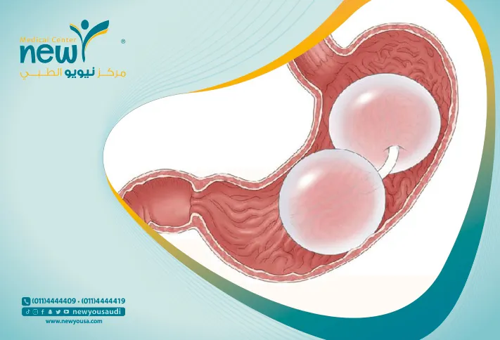 تعرف علي سعر البالون المبرمج من خلال مركزنا الطبي وايضا تكلفة البالون المبرمج