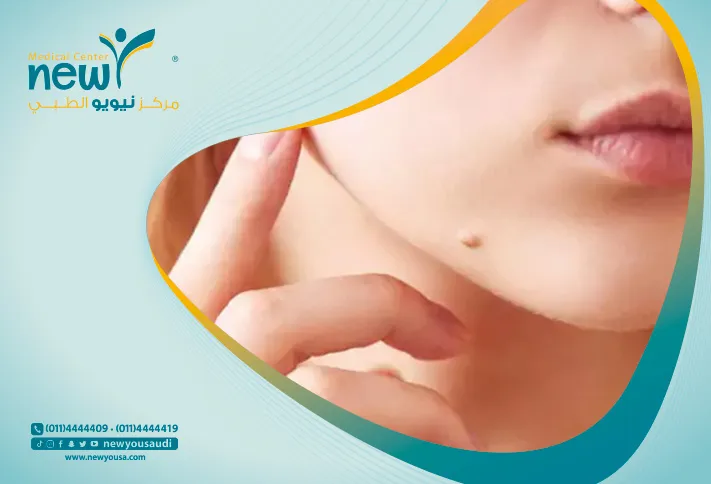 علاج الزوائد الجلدية تعرف عليه من خلال مركزنا الطبي في السعودية | نيويو