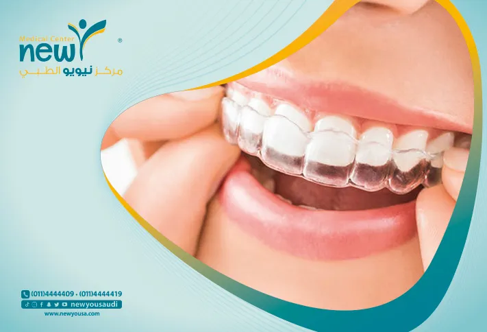 التقويم الشفاف كل ما تريد معرفته عنه من خلال مركزنا الطبي في السعودية | نيويو