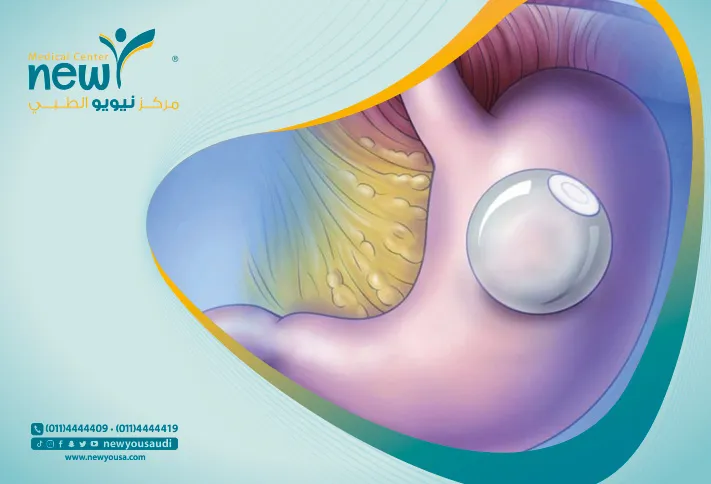 عملية البالون الذكي في السعودية تكلفة بالون المعدة  كل ما عليك معرفته