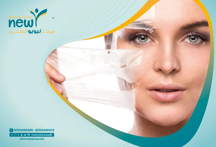 جلسات التقشير البارد للوجه بطريقة التقشير البارد
