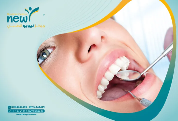 الحشوات التجميلية بافضل اسعار حشوات الاسنان بالرياض