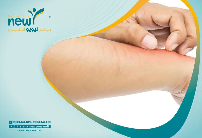 أكزيما اليد تعرف عليه من خلال مركزنا الطبي في السعودية | نيويو