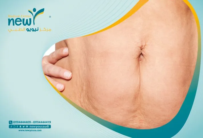 تجربتي مع الترهل بعد التكميم | مركز نيويو الطبي