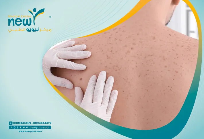 انواع عمليات زراعة الجلد او تمديد الجلد - مركز نيويو الطبي