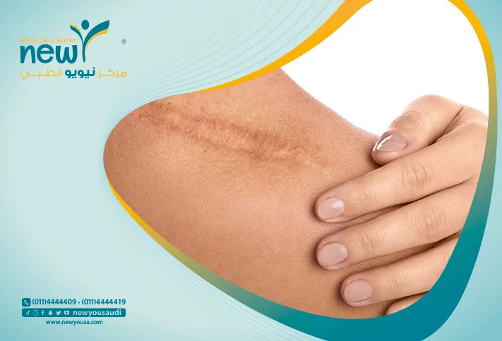 الندبات الجراحية كل ما تريد معرفته عنها من خلال مركزنا الطبي في السعودية | نيويو