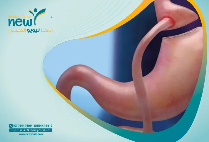 عملية تكميم المعدة في السعودية سعر عملية تكميم المعدة كل ما عليك معرفته