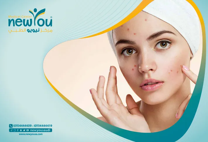 ندوب حب الشباب تعرف عليه من خلال مركزنا الطبي في السعودية | نيويو