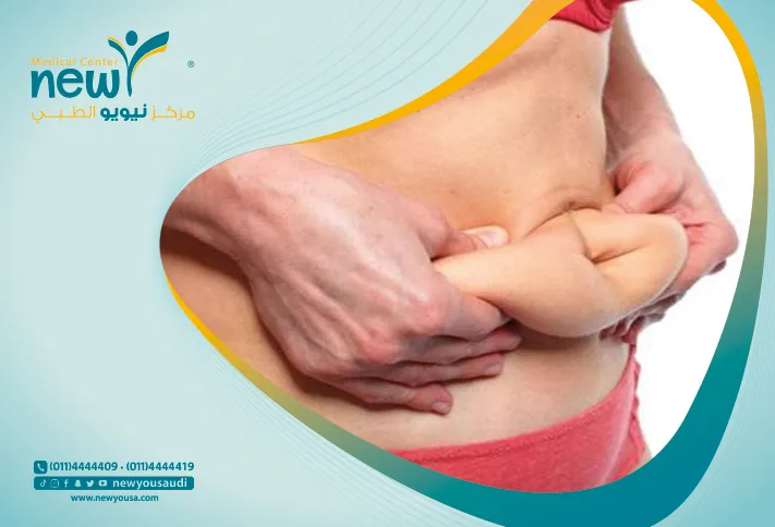 ترهلات البطن بعد الولادة كل ما تريد معرفته عنها من خلال مركزنا الطبي في السعودية | نيويو