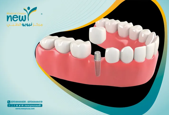 عمليات زراعه الاسنان كل ما تريد معرفته عنها من خلال مركزنا الطبي في السعودية | نيويو