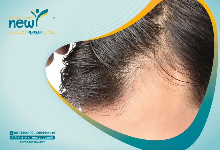 اورام جلد الراس والعنق تعرف عليه من خلال مركزنا الطبي في السعودية | نيويو