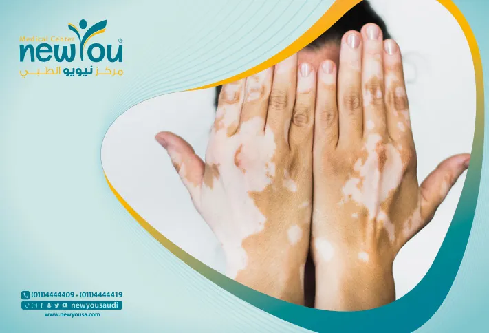 البهاق تعرف عليه من خلال مركزنا الطبي في السعودية | نيويو