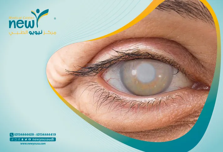 اعراض الماء الابيض كل ما تريد معرفته عنها من خلال مركزنا الطبي في السعودية | نيويو