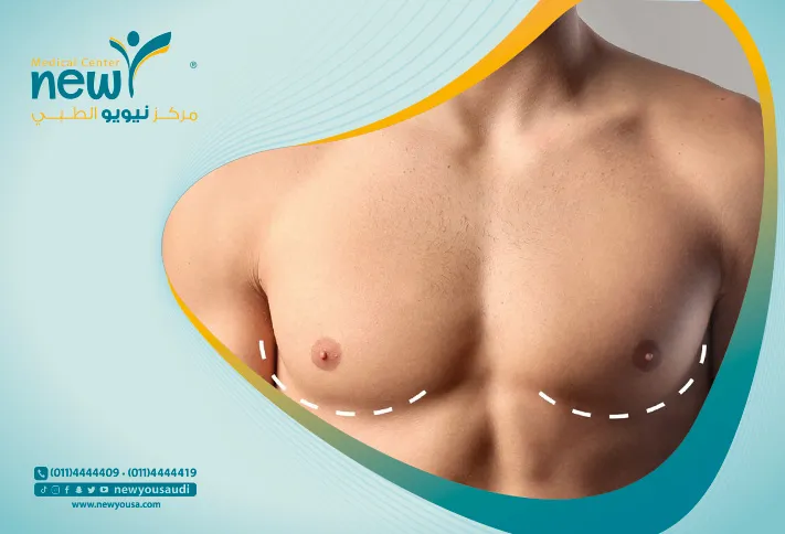 علاج التثدي عند الرجال كل ما تريد معرفته عنه من خلال مركزنا الطبي في السعودية | نيويو