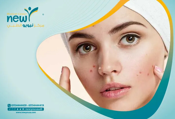 اعراض حب الشباب تعرف عليه من خلال مركزنا الطبي في السعودية | نيويو