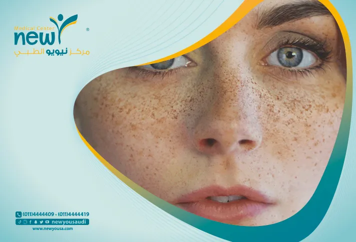 إزالة النمش كل ما تريدي معرفته عنه من خلال مركزنا الطبي في السعودية | نيويو