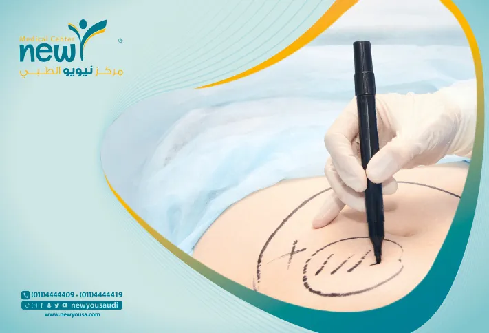 افضل دكتور شفط دهون بالرياض | مركز نيويو الطبي