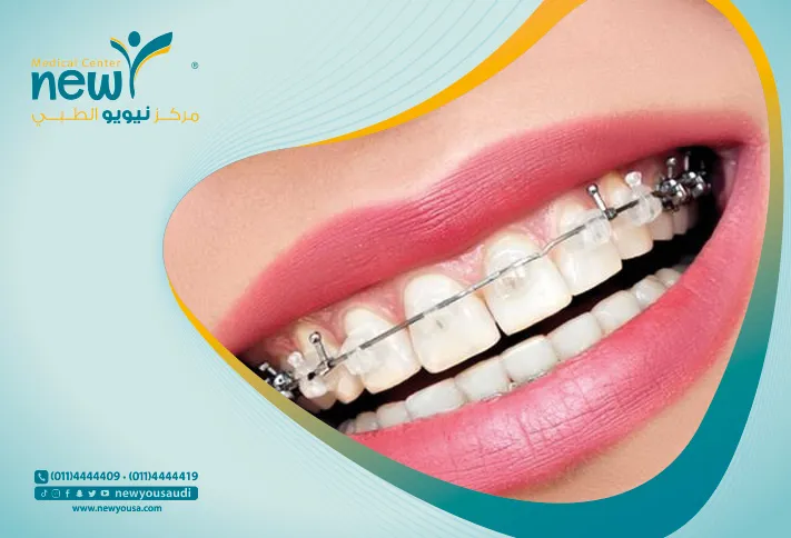 تنظيف تقويم الأسنان كل ما تريد معرفته عنه من خلال مركزنا الطبي في السعودية | نيويو