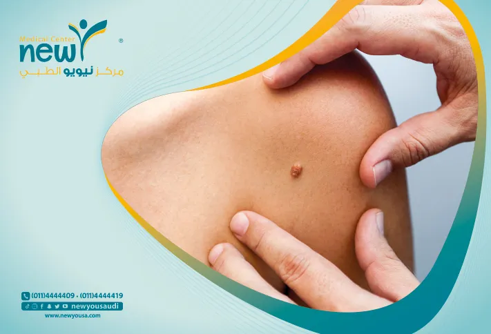 الحل النهائي للتخلص من الثآليل مع خبراء مركز نيويو الطبي