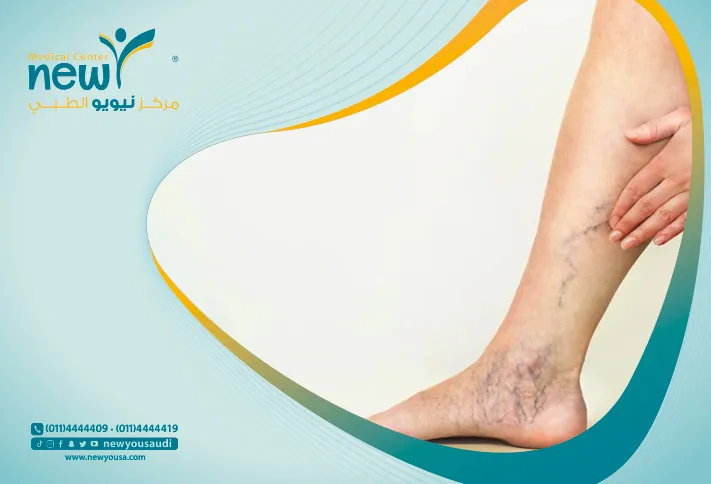 الدوالي تعرف عليه من خلال مركزنا الطبي في السعودية | نيويو