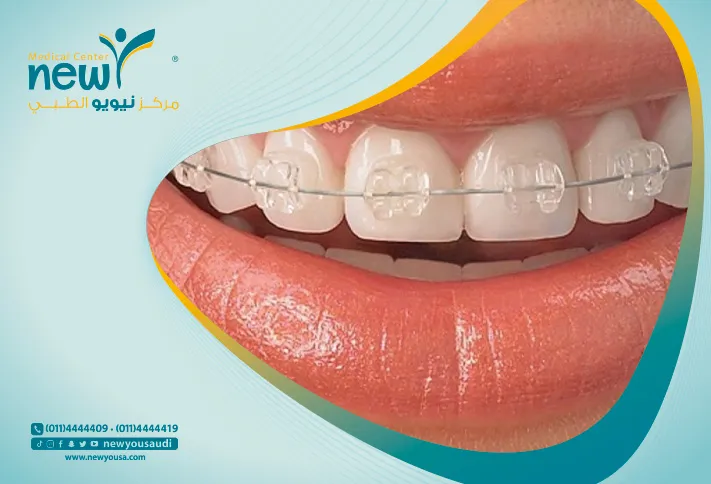 مثبت الاسنان بعد التقويم هل هي فعلاً ضرورية؟!