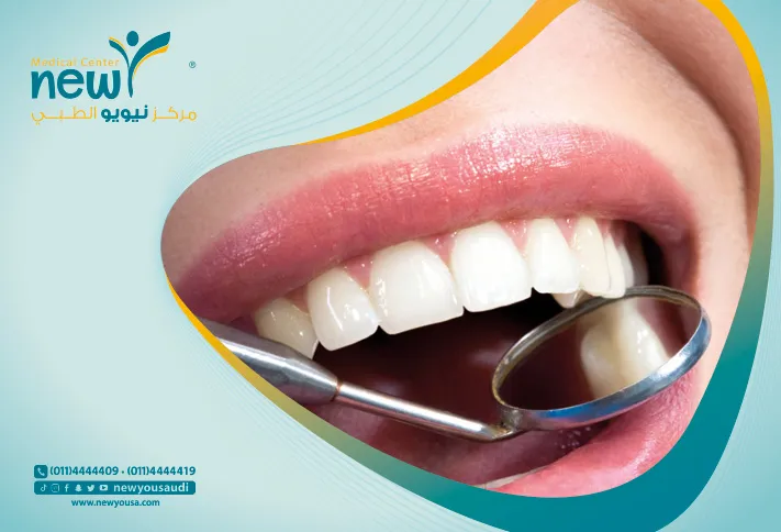 قشور الاسنان كل ما تريد معرفته عنها من خلال مركزنا الطبي في السعودية | نيويو