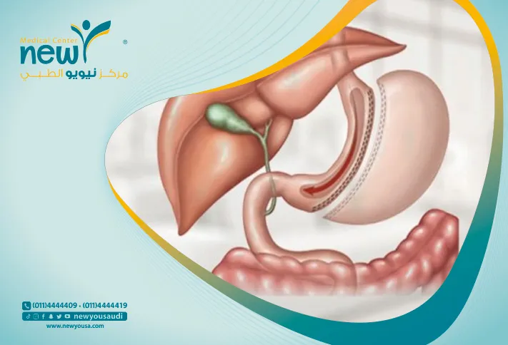 عملية تكميم المعدة في السعودية سعر تكميم المعدة كل ما عليك معرفته
