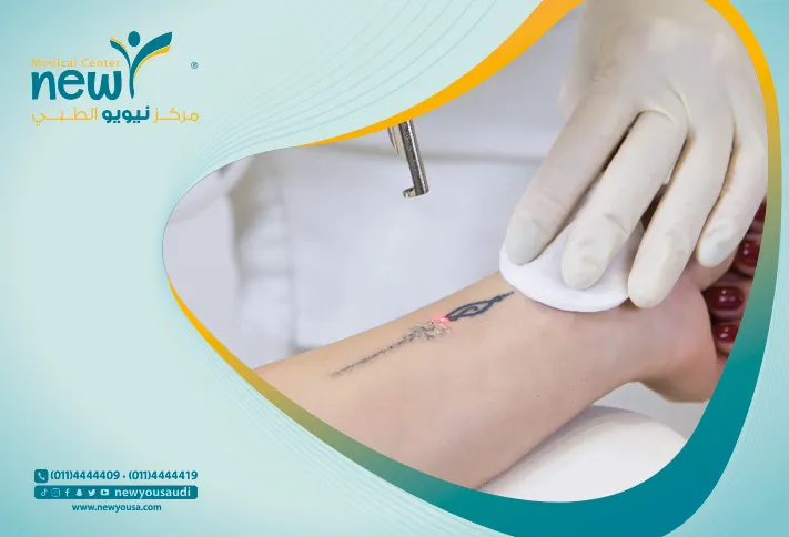 أسعار واماكن إزالة الوشم بالليزر تعرف عليه من خلال مركزنا الطبي في السعودية | نيويو