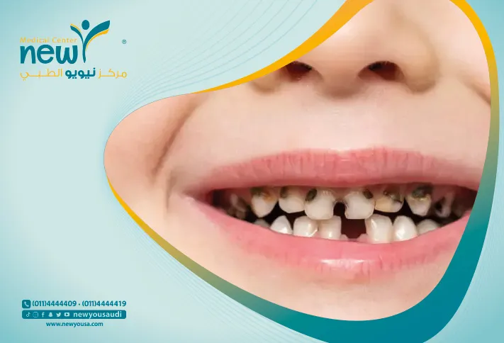 تسوس الاسنان تعرف عليه من خلال مركزنا الطبي في السعودية | نيويو