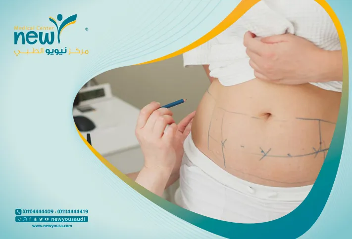 النحت البارد كل ما تريدي معرفته عنه من خلال مركزنا الطبي في السعودية | نيويو