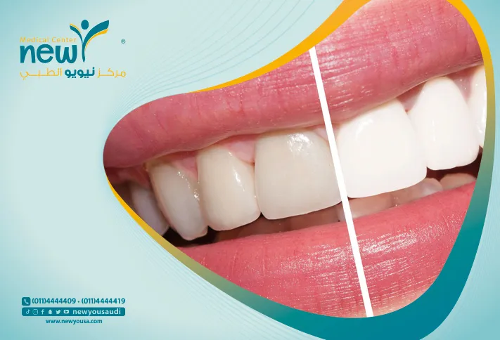 اسباب تغير لون الأسنان إلى الرمادي كل ما تريد معرفتها عنه من خلال مركزنا الطبي في السعودية | نيويو