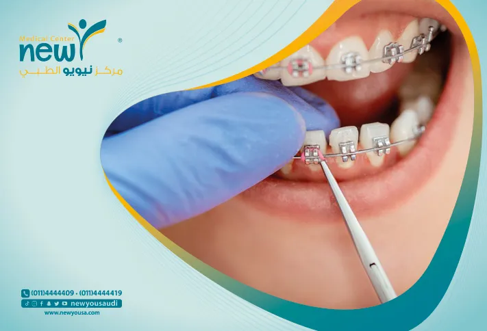 تقويم الأسنان كل ما تريد معرفته عنه من خلال مركزنا الطبي في السعودية | نيويو