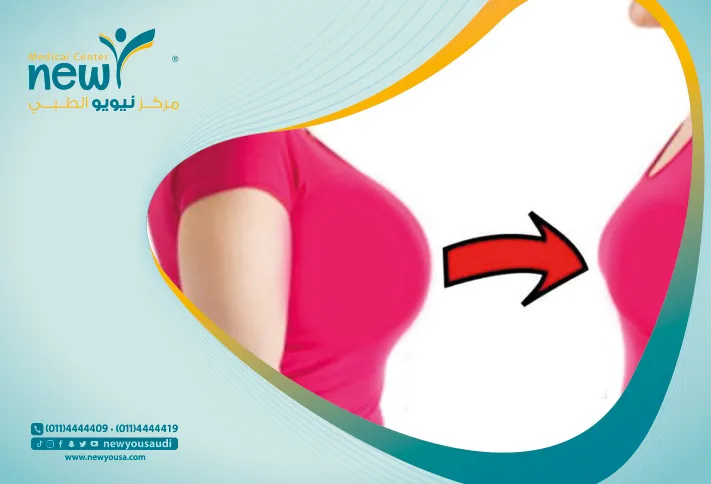 عملية شد الثدي كل ما تريدي معرفته عنها من خلال مركزنا الطبي في السعودية | نيويو