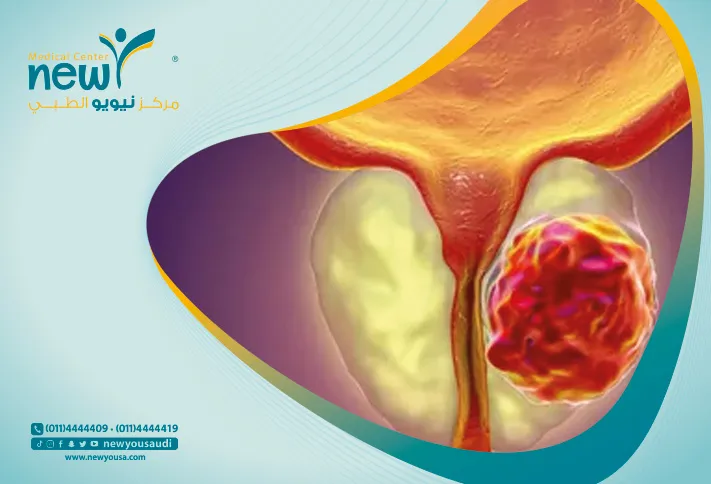 التهاب البروستاتا كل ما تريد معرفته عنه من خلال مركزنا الطبي في السعودية | نيويو