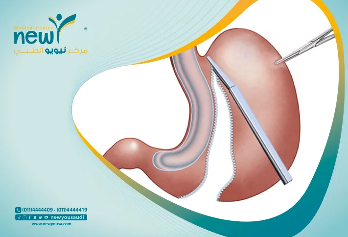 جراحة تكميم المعدة كل ما تريد معرفته عنها من خلال مركزنا الطبي في السعودية | نيويو
