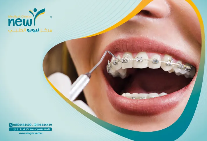 تقويم الأسنان كل ما تريد معرفته عنه من خلال مركزنا الطبي في السعودية | نيويو