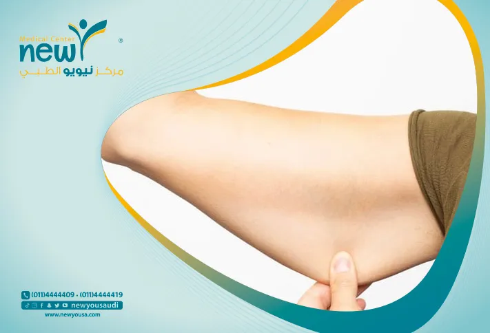 عملية شد الذراعين كل ما تريد معرفته عنها من خلال مركزنا الطبي في السعودية | نيويو