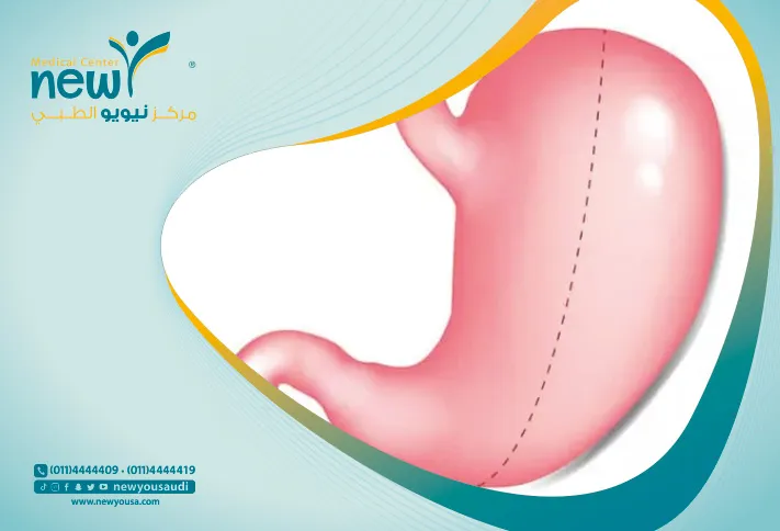 التكميم في الرياض في السعودية سعر عملية تكميم الرياض كل ما عليك معرفته