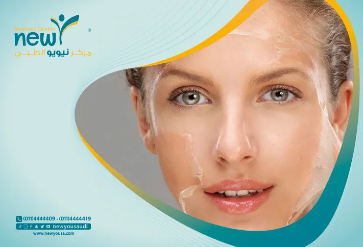 تقشير الوجه بالليزر كل ما تريدي معرفته عنه من خلال مركزنا الطبي في السعودية | نيويو