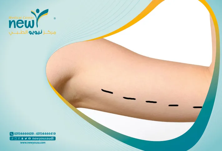 عملية شد الذراعين كل ما تريد معرفته عنه من خلال مركزنا الطبي في السعودية | نيويو