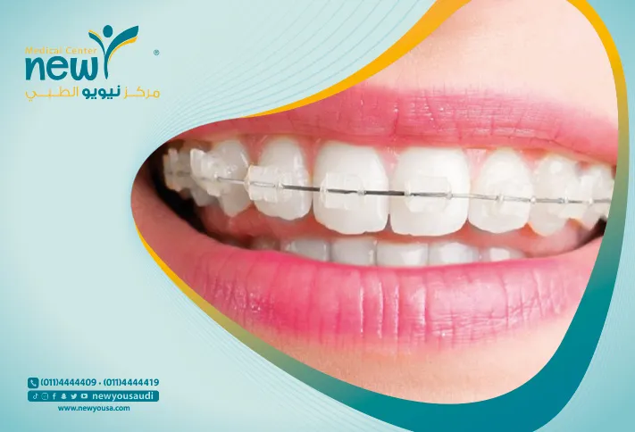 المعالجة التقويمية كل ما تريد معرفته عنها من خلال مركزنا الطبي في السعودية | نيويو